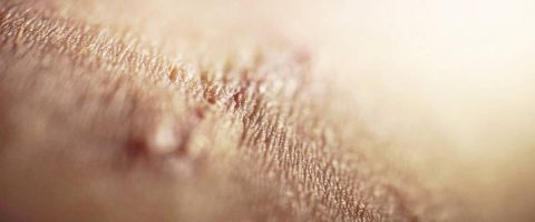 נכות בגין צלקת מכערת בענף נפגעי עבודה