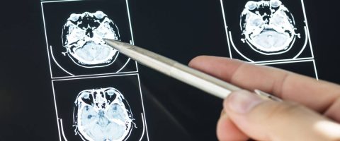 מנינגיומה מדריך זכויות