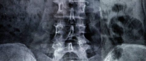 נכות בגין אוסטיאופורוזיס או אוסטאופניה