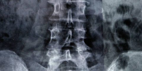 נכות בגין אוסטיאופורוזיס או אוסטאופניה