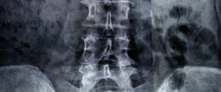 נכות בגין אוסטיאופורוזיס או אוסטאופניה